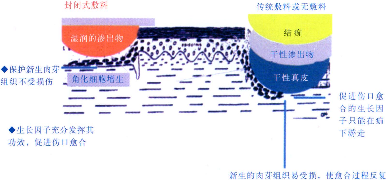 二、濕性傷口愈合理論